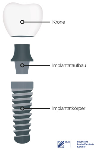 Zahn-Implantat